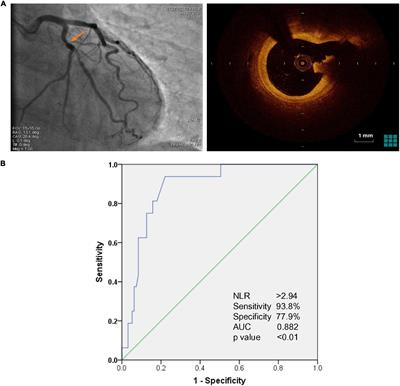 Association of Neutrophil to Lymphocyte Ratio With Plaque Rupture in Acute Coronary Syndrome Patients With Only Intermediate Coronary Artery Lesions Assessed by Optical Coherence Tomography